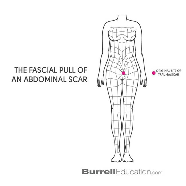 human diagram of scar tissue and fascia
